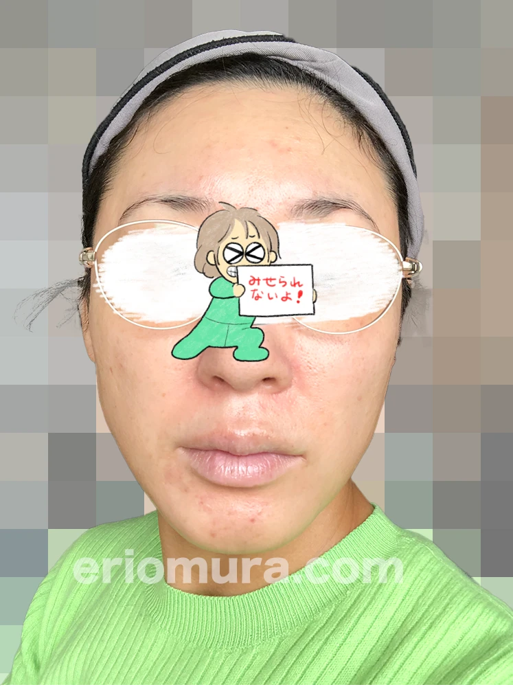 光フェイシャルを受けてみた。