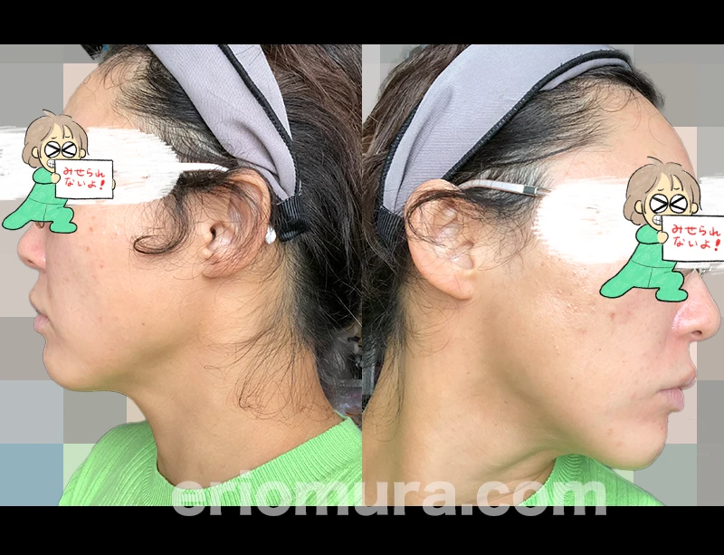 光フェイシャルを受けてみた。