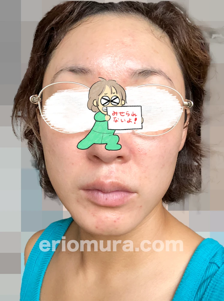 光フェイシャルを受けてみた。