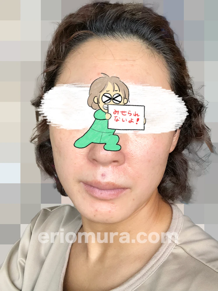 光フェイシャルを受けてみた。