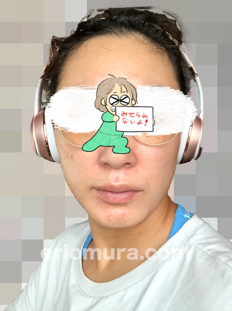 光フェイシャルを受けてみた。