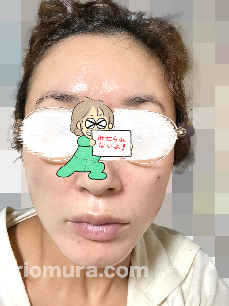 光フェイシャルを受けてみた。