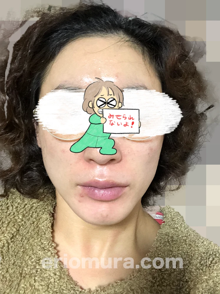 光フェイシャルを受けてみた。