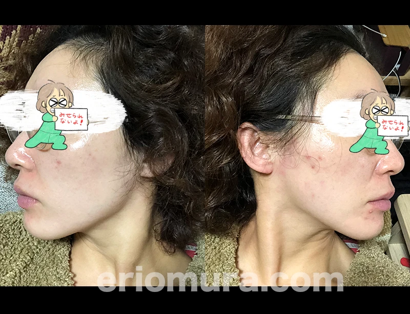 光フェイシャルを受けてみた。