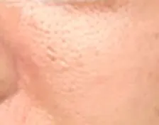 光フェイシャルを受けてみた。