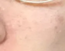 光フェイシャルを受けてみた。